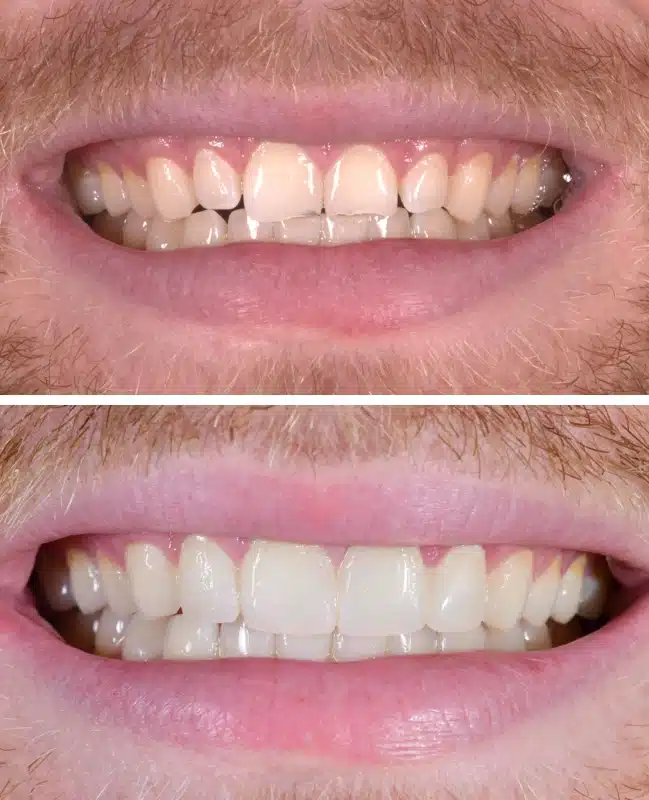 img-cosmetic-bonding-before-after-three