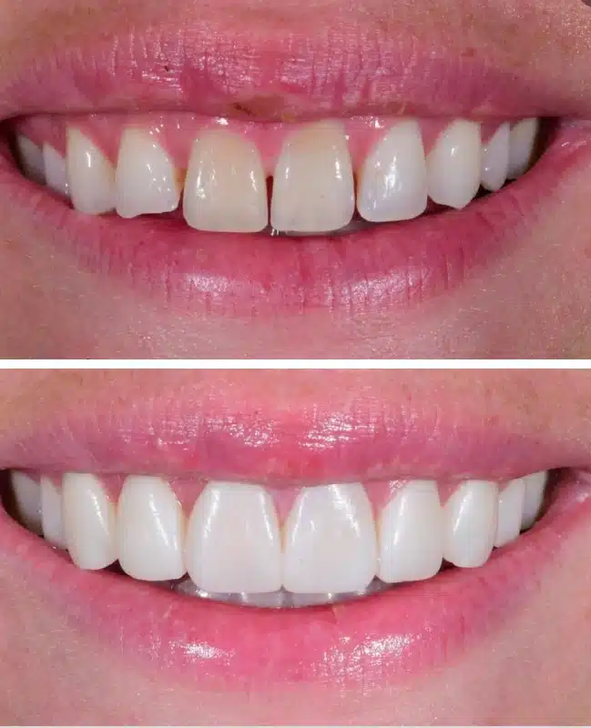 img-cosmetic-bonding-before-after-two