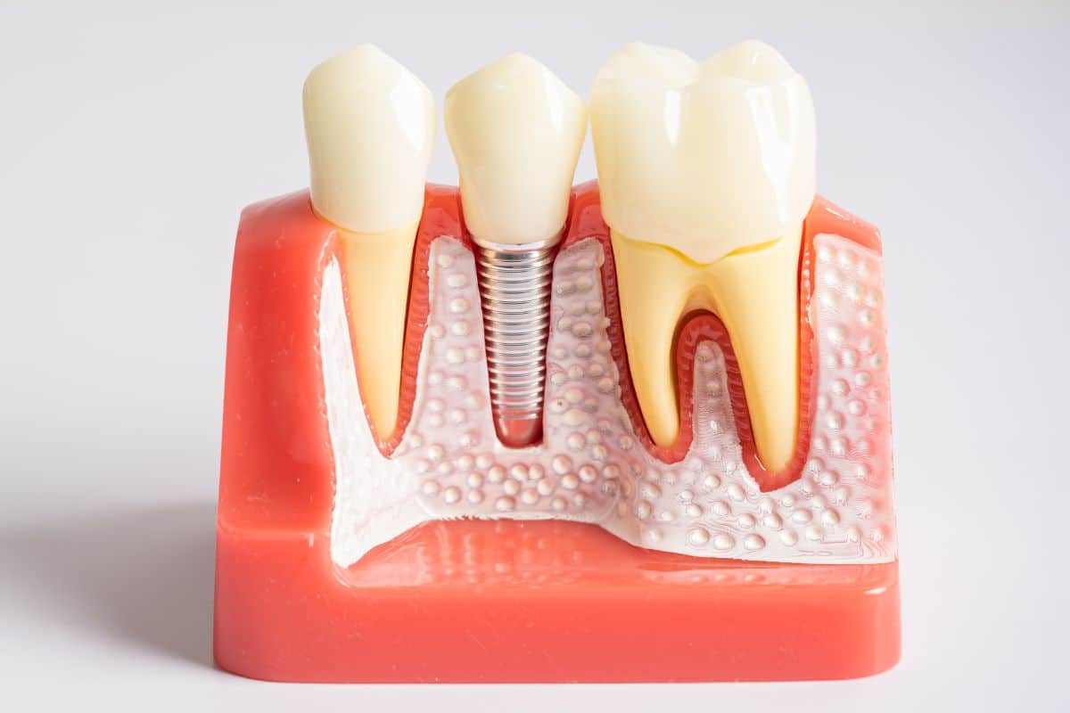 What to Expect When Getting Dental Implants in Phoenix