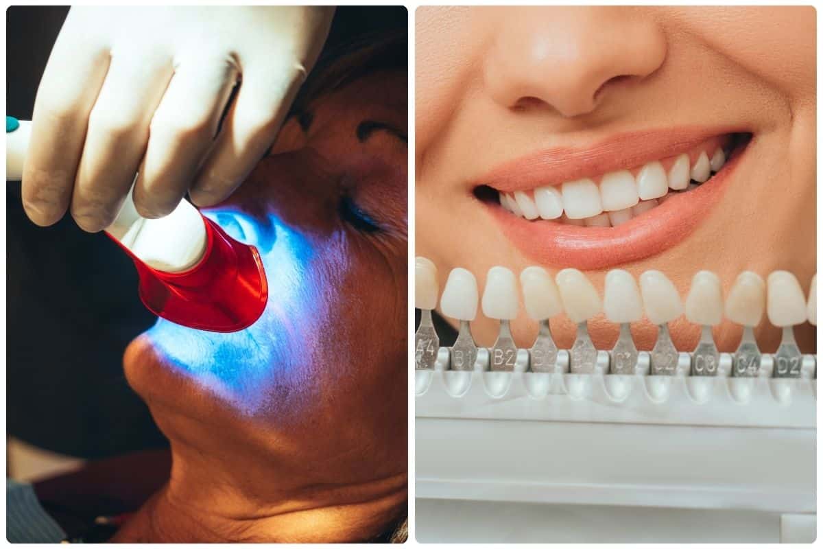 Teeth Whitening & Veneers
