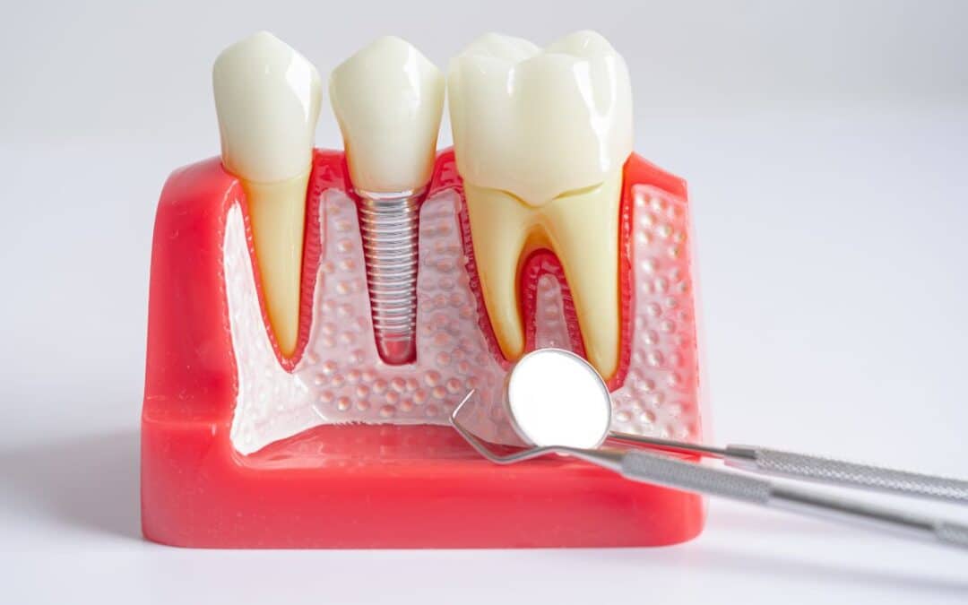 Am I a Good Candidate for Dental Implants? Here’s How to Know for Sure