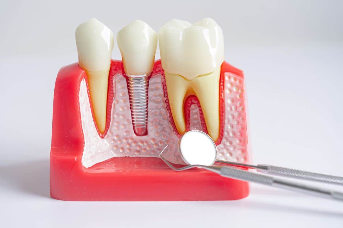 Artificial Dental Implants Module Showcase at the Dental Officei in Phoenix