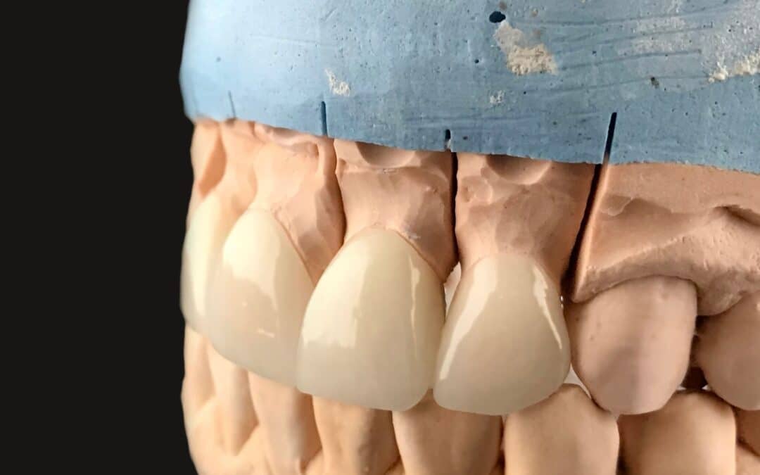 Tired of Stained or Uneven Teeth? Dental Veneers Might Be the Answer