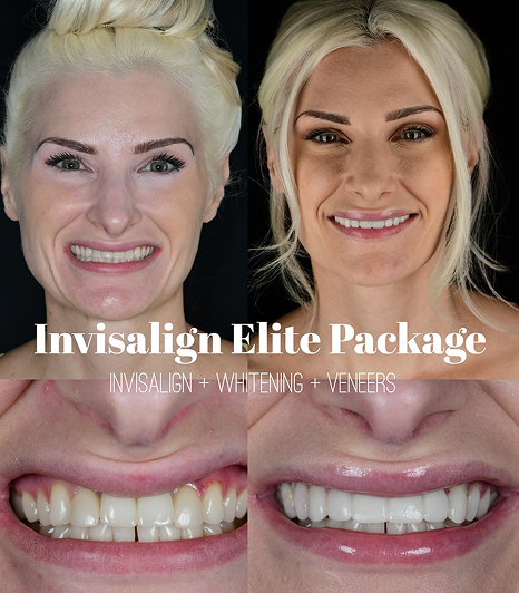 Invisalign Elite Package