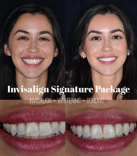 Invisalign Signature Package