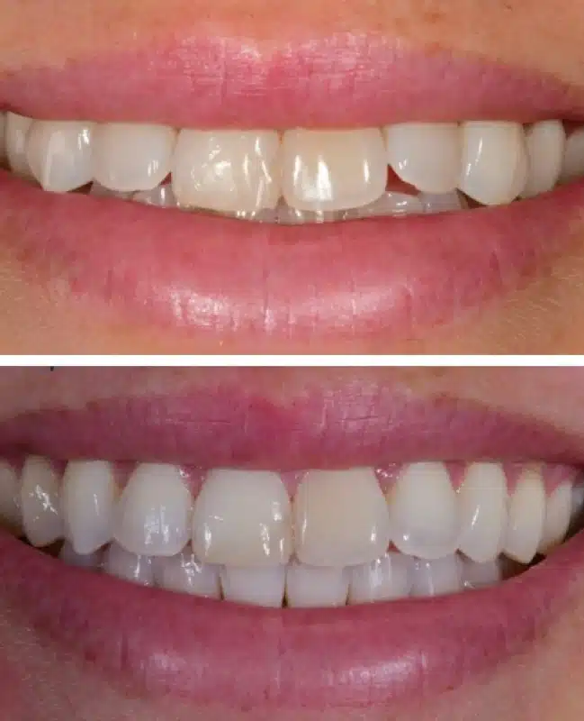 Patient before and after Invisalign treatment demonstrating noticeable smile improvement