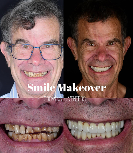 Smile Makeover
