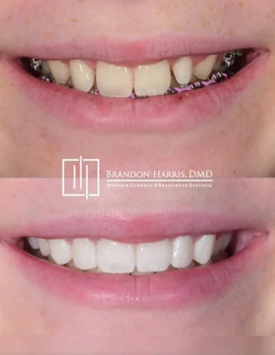 Smile makeover with cosmetic bonding improving uneven front teeth