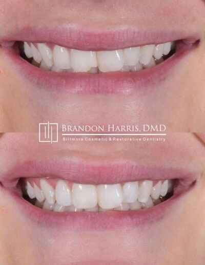 Before and after cosmetic bonding for damaged front teeth