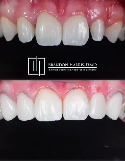 Cosmetic bonding closing gaps and reshaping front teeth
