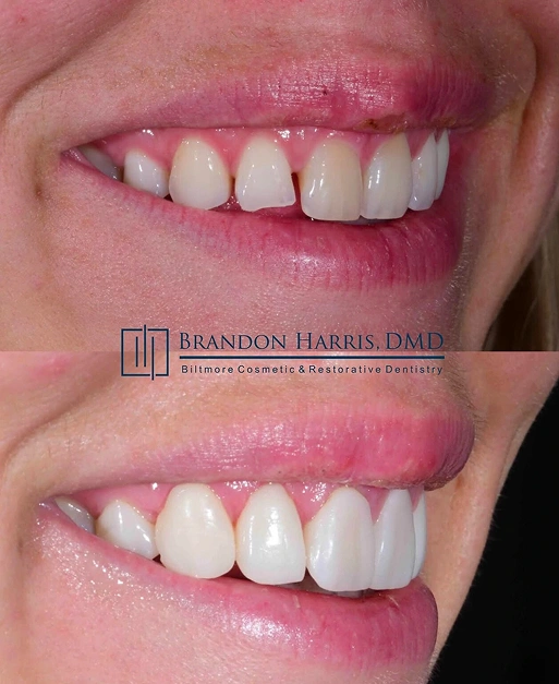 Before and after cosmetic bonding treatment repairing chipped front teeth and enhancing smile appearance
