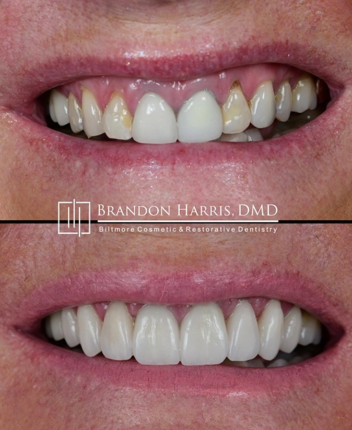 Before and after cosmetic bonding results creating a brighter, more natural-looking smile