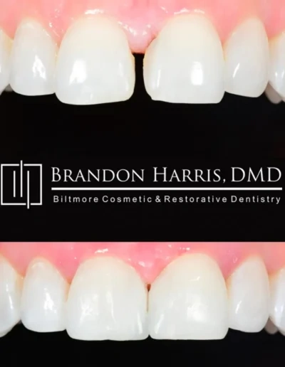 Restorative dental bonding rebuilding chipped upper front teeth