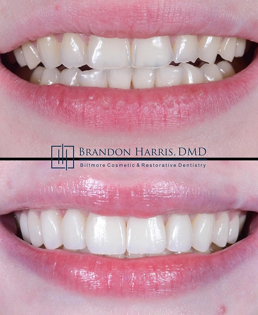 Full-mouth cosmetic bonding before and after smile transformation with improved tooth shape and symmetry
