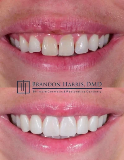Cosmetic dentistry bonding results creating a fuller natural smile