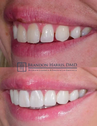 Cosmetic bonding smile makeover showing improved front teeth alignment