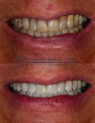 Veneers correcting discoloration and uneven teeth for a brighter smile