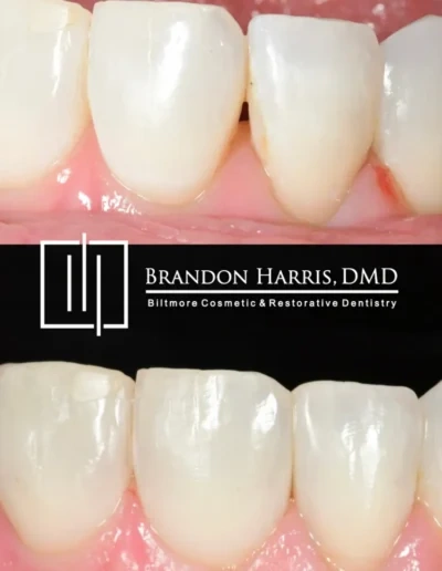 Close-up cosmetic dental bonding enhancing tooth shape and symmetry