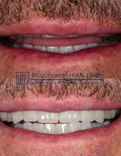 Veneers before and after results with enhanced smile symmetry and brighter teeth