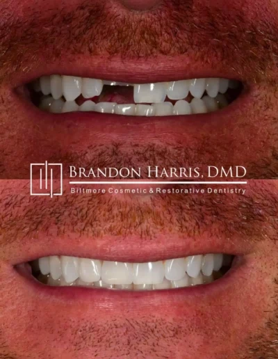 Veneers closing gaps and creating a more balanced smile