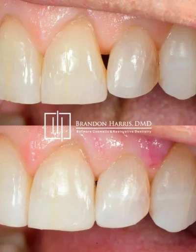 Before and after dental bonding repair for chipped front tooth