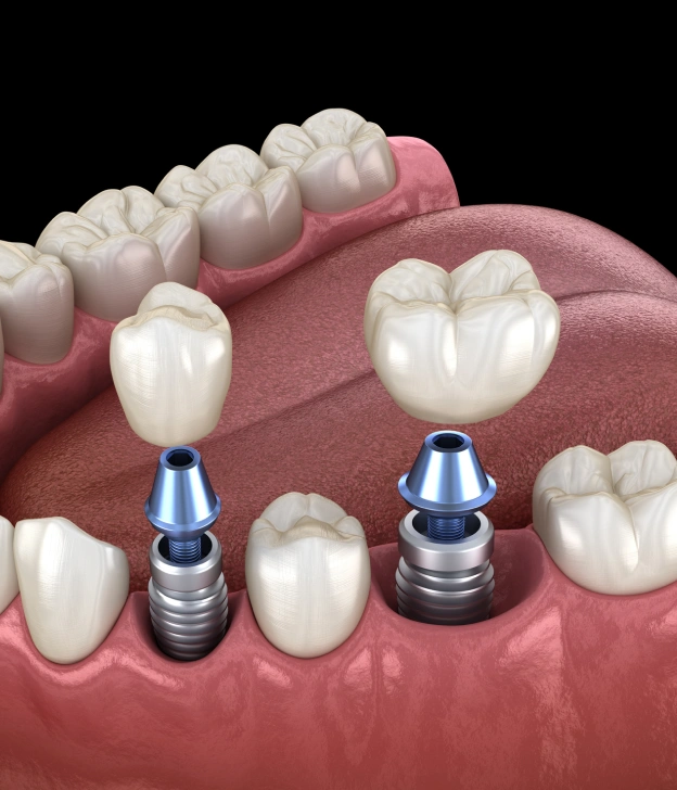 A 3D model illustrating how titanium dental implants and crowns fit into the jawbone, next to text about permanent solutions for missing teeth in Phoenix.