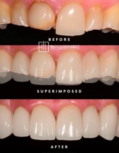 Before and after veneer treatment correcting discolored and uneven teeth