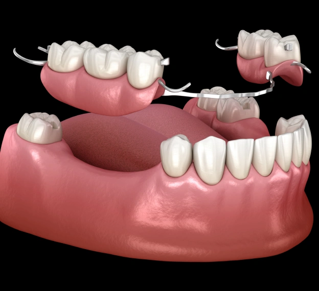A 3D model illustrating a removable partial denture framework being fitted onto a lower jaw, next to text about comfortable dentures and bridges in Phoenix.