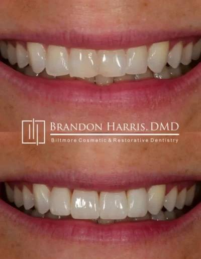 Porcelain veneers smile makeover with improved tooth alignment and aesthetics