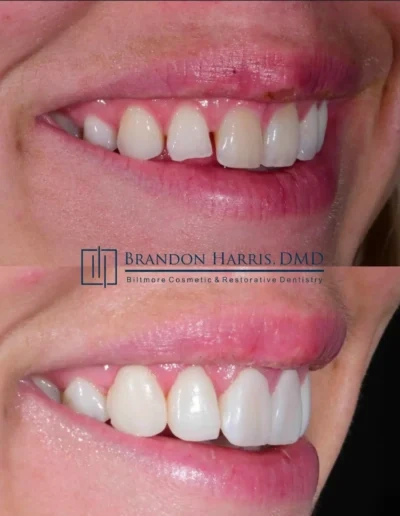 Side view cosmetic bonding treatment improving chipped front teeth