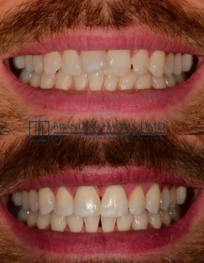 Invisalign results improving overall tooth alignment and smile appearance
