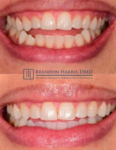 Invisalign treatment correcting spacing and alignment of front teeth