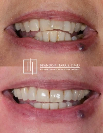 Invisalign before and after results improving crowded front teeth