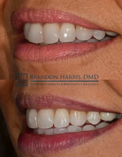 Side view smile improvement following Invisalign orthodontic treatment