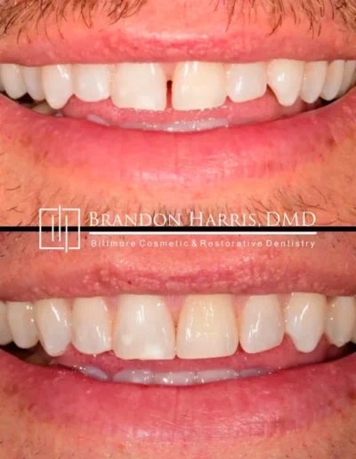 Invisalign treatment closing gap between upper front teeth