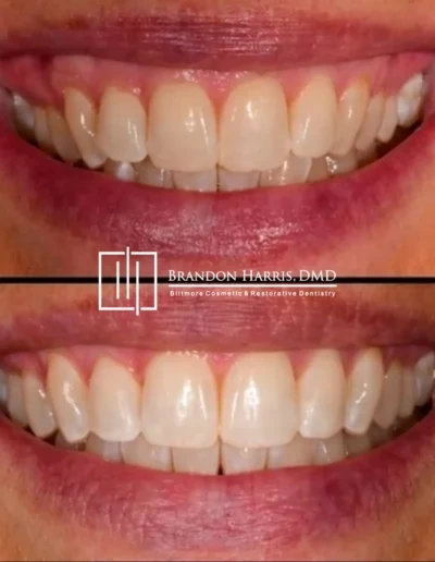 Invisalign smile transformation creating straighter and more even teeth