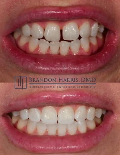 Before and after Invisalign treatment for crowded lower teeth