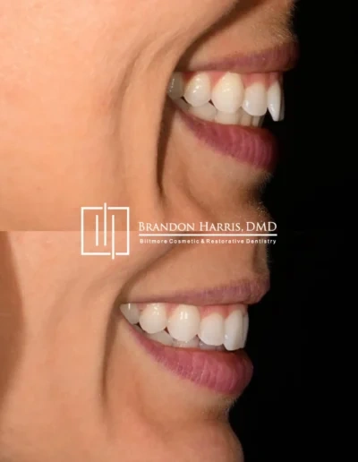 Side profile Invisalign treatment correcting front tooth alignment issues