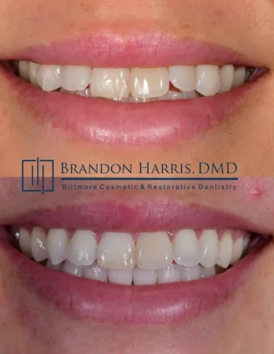 Straighter smile achieved with Invisalign clear aligner treatment