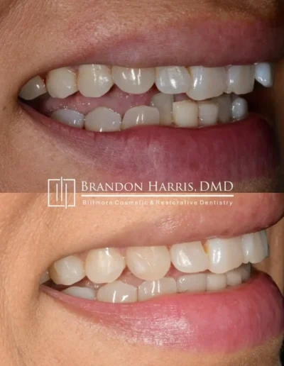 Side view Invisalign correction for overlapping front teeth