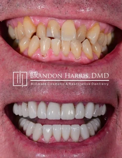 Veneers enhancing tooth shape and creating a more uniform smile