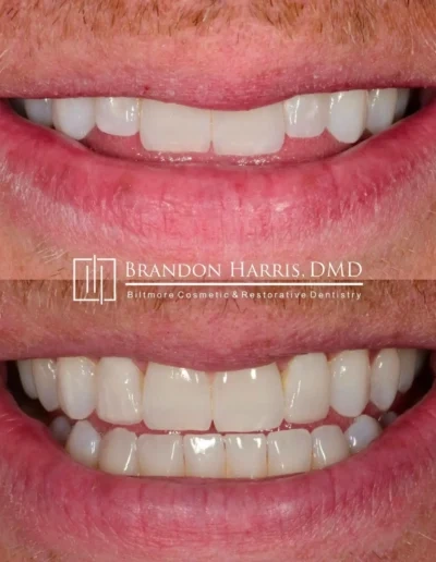 Cosmetic veneer treatment transforming worn and chipped front teeth