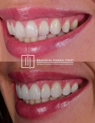 Smile makeover with porcelain veneers before and after dental restoration