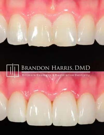 Before and after veneers correcting gaps and enhancing smile appearance