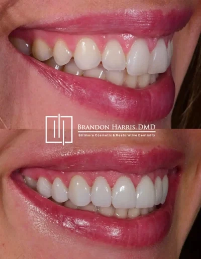 Veneer smile transformation with improved tooth color and contour