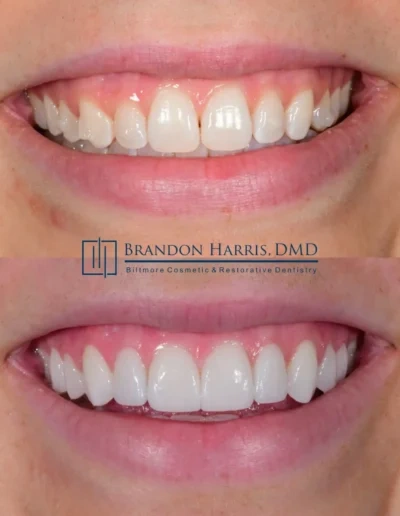 Veneers creating a brighter, fuller, and more symmetrical smile