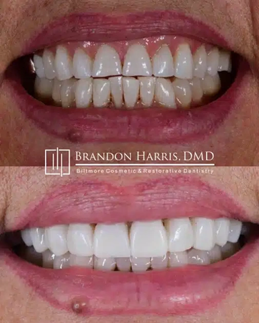 Teeth whitening transformation at Biltmore Cosmetic & Restorative Dentistry