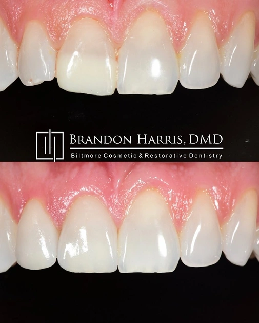 Close-up of professional teeth whitening results with brighter teeth