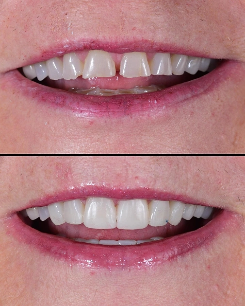 Cosmetic teeth whitening results creating a whiter, more confident smile