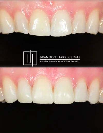Restorative dentistry bonding treatment improving worn front teeth appearance